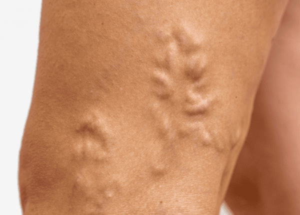 Úlcera Venosa - Causas, Tratamentos e Curativos